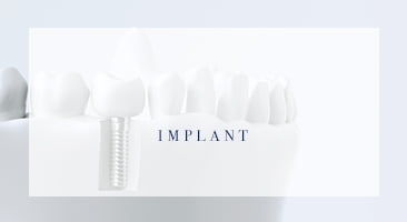 インプラントをご検討の方へ IMPLANT